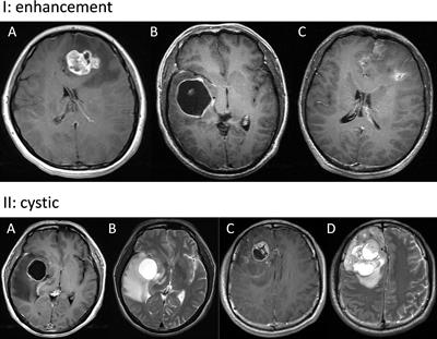 Differential Predictors and Clinical Implications Associated With Long-Term Survivors in IDH Wildtype and Mutant Glioblastoma